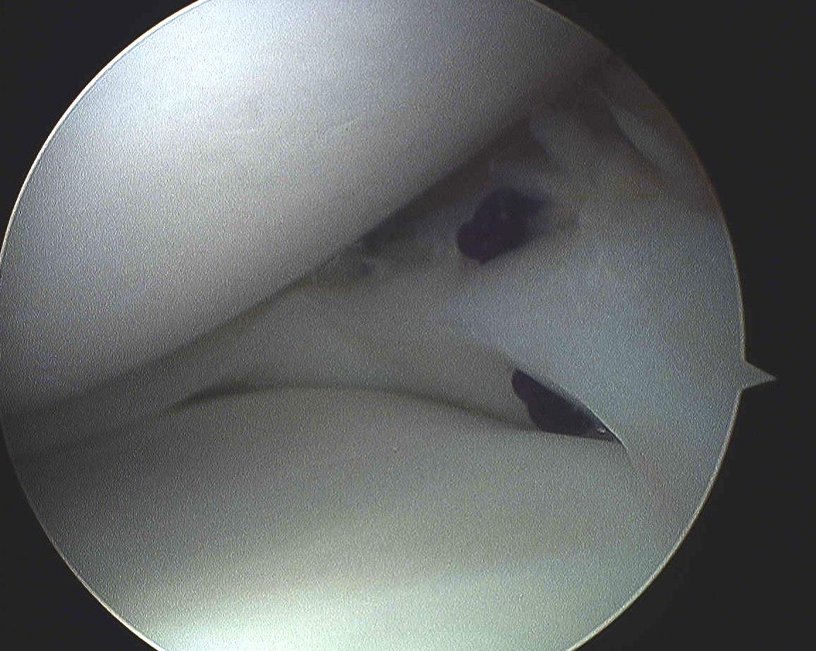 Anterior horn meniscal tear Repair 2